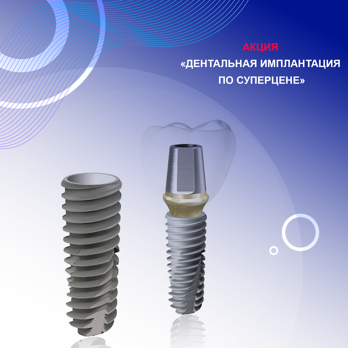 ДЕНТАЛЬНАЯ ИМПЛАНТАЦИЯ ПО СУПЕРЦЕНЕ