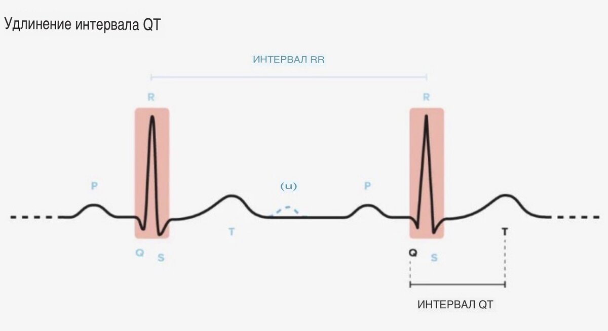 Синдром удлиненного интервала QT - Humanitas
