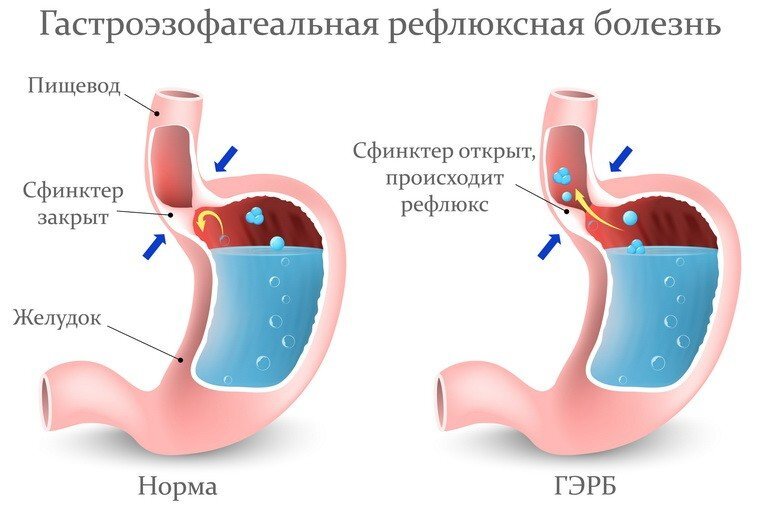 Рефлюкс-эзофагит (ГЭРБ) – лечение, симптомы и диагностика рефлюкс-эзофагита (ГЭРБ) в «СМ-Клиника»