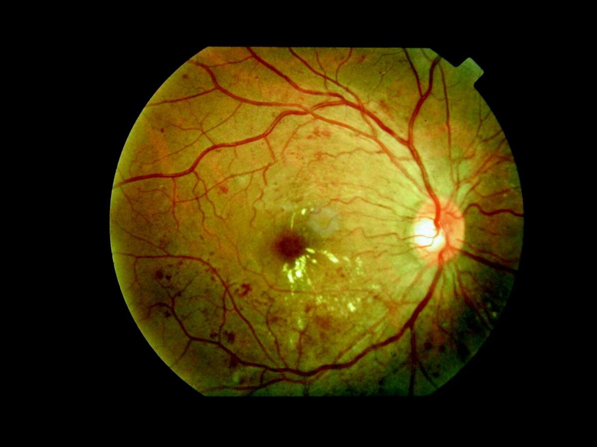 Ретинопатия диабетическая фото глаза