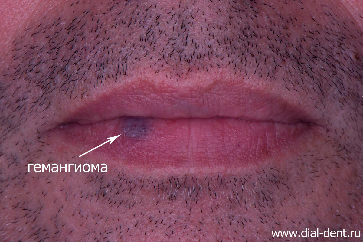 гемангиома на губе - вид при обращении
