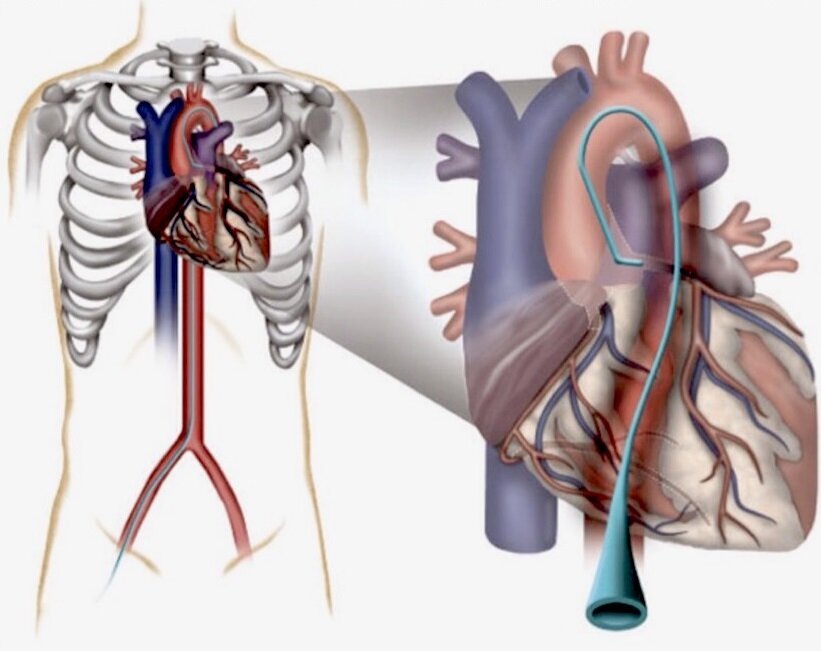 Катетеризация сердца