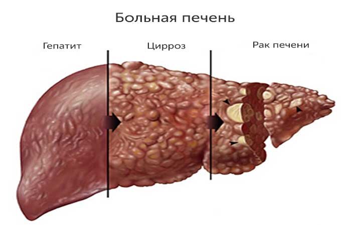 Горечь во рту: причины, лечение, профилактика