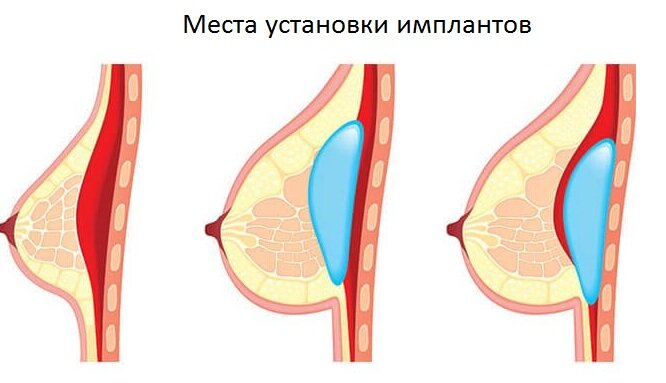 БОЛЬШАЯ ГРУДЬ - ЭТО КРАСИВО ИЛИ ВУЛЬГАРНО? ПОЧЕМУ МАЛЕНЬКАЯ ГРУДЬ ЛУЧШЕ?