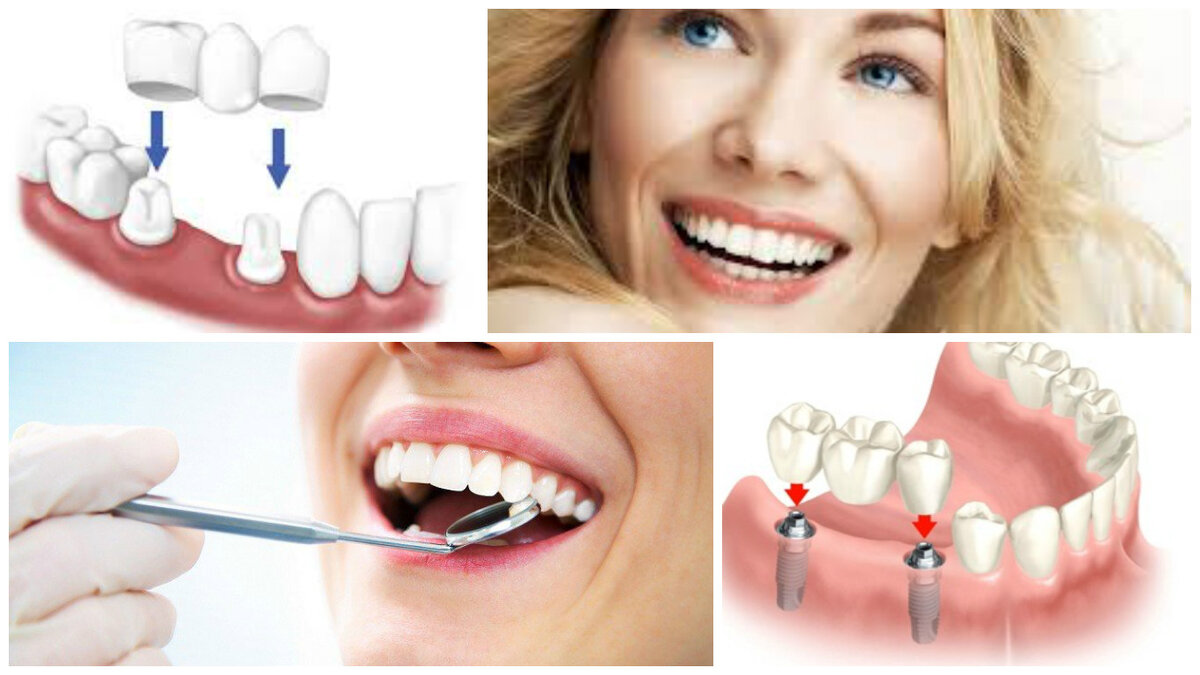 Протезирование на имплантах