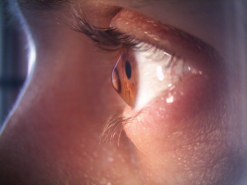 Кератоконус