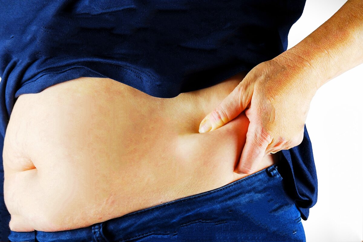 Выраженный лишний вес.