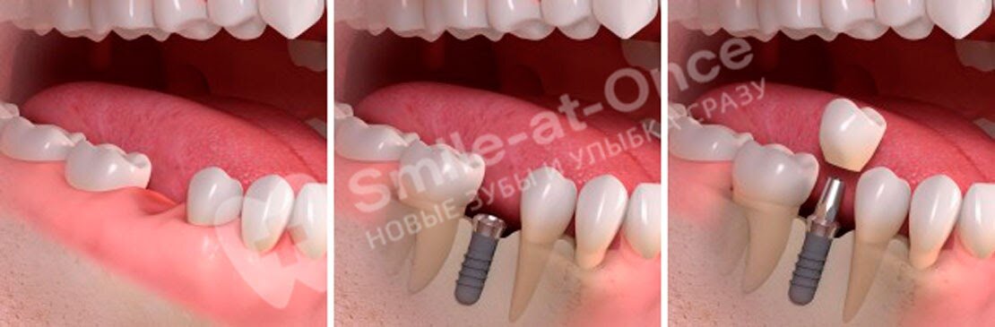 После установки 1-2 одиночных имплантов ограничения физической активности достаточно легкие. Фото: Smile-at-Once.ru.
