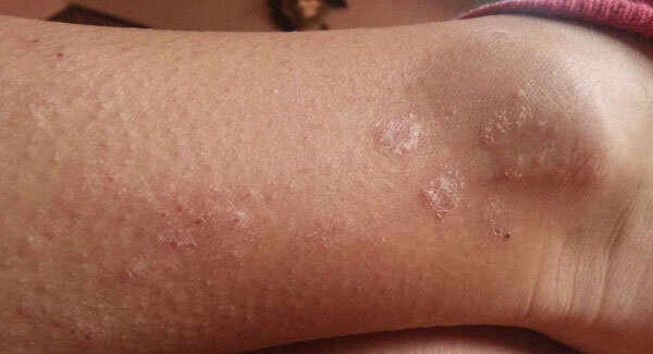 Источник - https://vascul.ru/articles/varicose-dermatitis