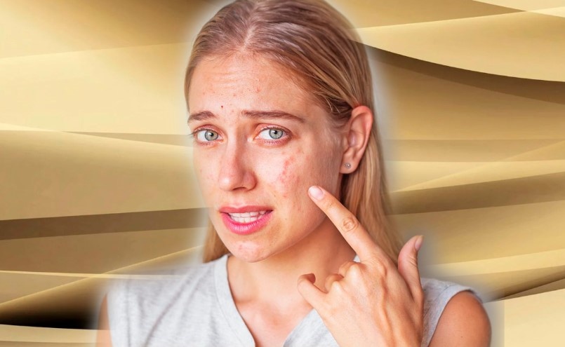 Рабочая схема для кожи с прыщиками и постакне, топ лучших компонентов против aкнe