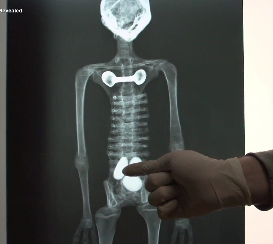 Рентгеновский снимок.
Источник фото: http://paranormal-news.ru/_nw/137/33627272.jpg