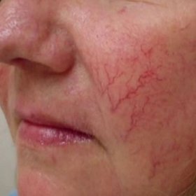 Купероз – это расширение капилляров, самых мелких кровеносных  сосудов. Внешне они выглядят как мелкая сосудистая сетка, просвечивающая  через кожу лица. В результате участки кожи выглядят красно-синюшными.  Всегда ли купероз свидетельствует, что человек злоупотребляет спиртным,  страдает хроническом алкоголизмом?