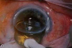 Кадр из операции по лечению катарки