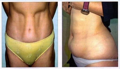 Липоатрофия и липогипертрофия
