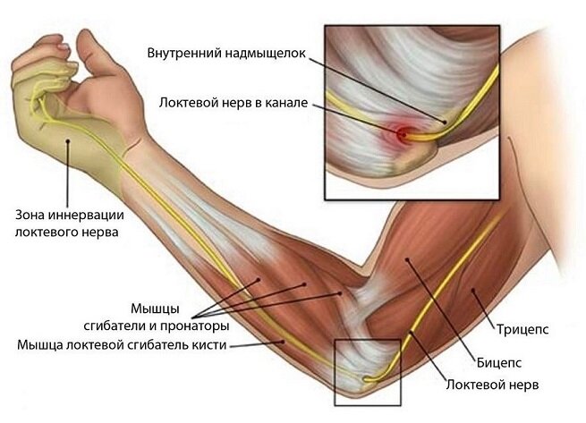 Как лечить невралгию в домашних условиях