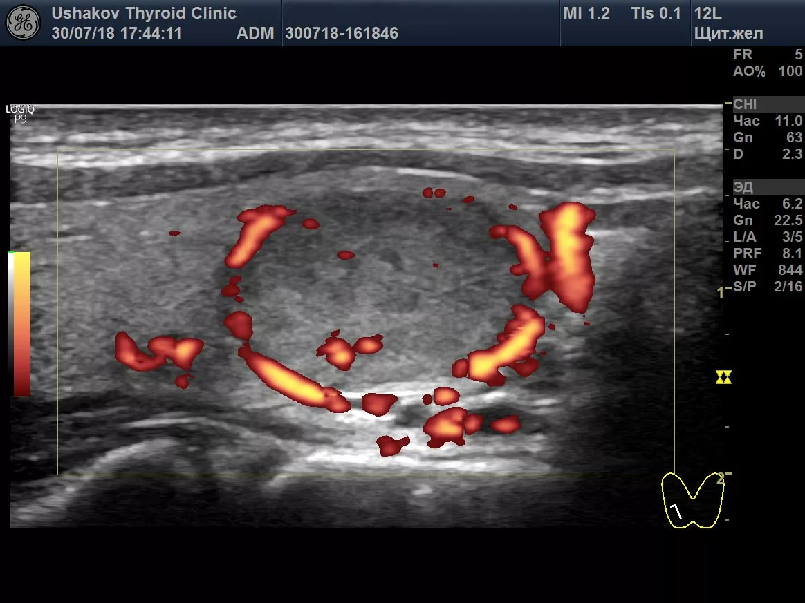 Солидный узел щитовидной. Эхограммы узлы щитовидной железы. Протокол УЗИ узел щитовидной железы. Губчатый узел щитовидной железы на УЗИ. Загрудинный узел щитовидной железы . УЗИ.