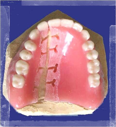 Починка линейного перелома базиса съемного пластиночного протеза. Переломы съемных протезов. Починка линейного перелома базиса съемного пластиночного протеза. Методы починок пластиночных протезов. Починка съемного протеза.