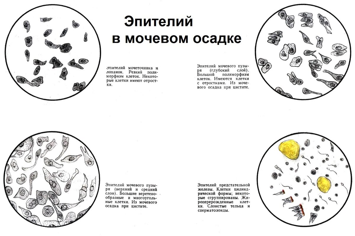 Общий анализ мочи с микроскопией осадка