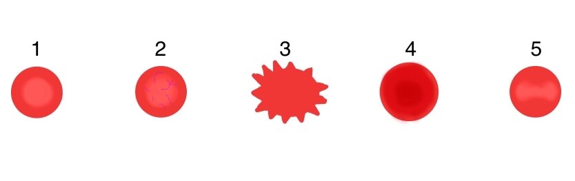 1 - Дискоцит
2 - Ретикулоцит
3 - Эхиноциты
4 - Сфероцит
5 - Стоматоцит