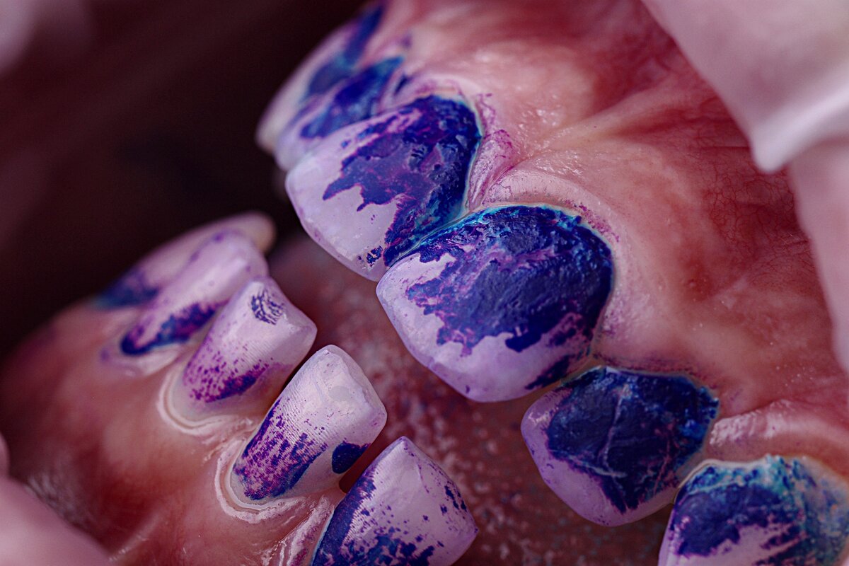 Индикация налёта на стоматологическом приеме