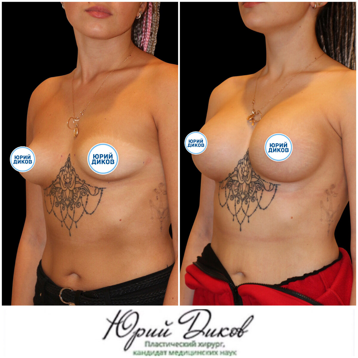 тубулярная деформация груди у женщин фото 89