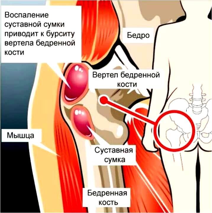 Бурсит бедра. Сумка большого вертела бедренной кости. Вертельная сумка тазобедренного сустава. Бурсит тазобедренного сустава. Бурсы тазобедренного сустава.