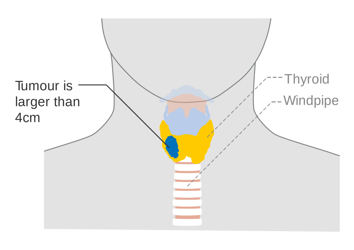 Изменение тканей щитовидной железы. Очаговое образование щитовидной железы. Очаговые изменения щитовидной железы. Очаговые образования в щитовидной железе.