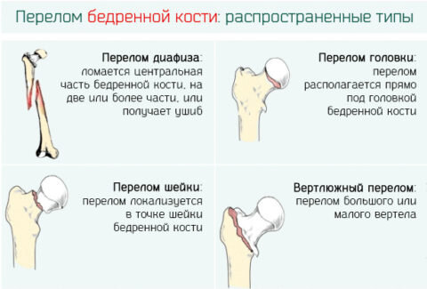  Существует определенная классификация переломов бедренной кости.