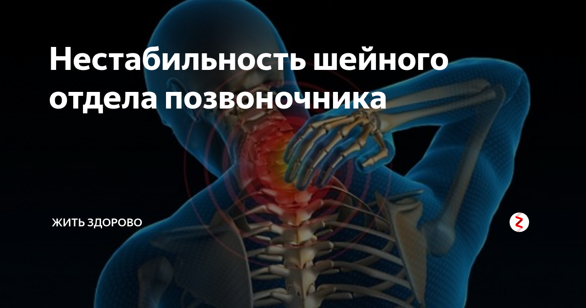 Нестабильность отдела позвоночника. Нестабильность позвоночника. Нестабильность шейных позвонков. Нестабильность позвонков шейного отдела. Нестабильный позвонок шейного отдела.