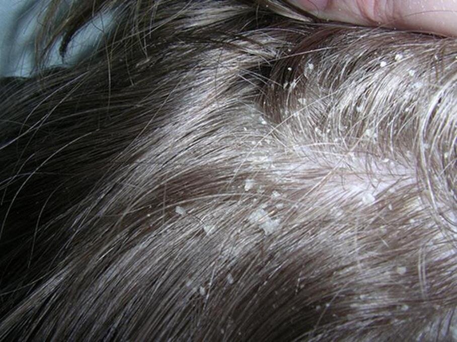 Лечение перхоти в домашних условиях от клиники «Доктор волос»