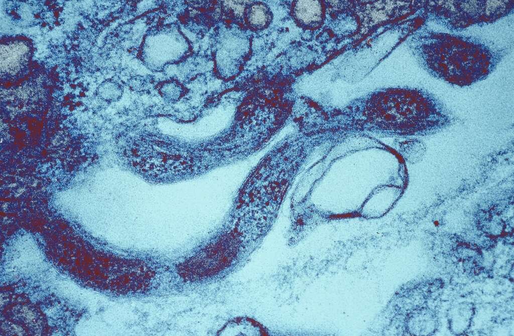 Небезопасные сексуальные практики привели к возвращению сифилиса