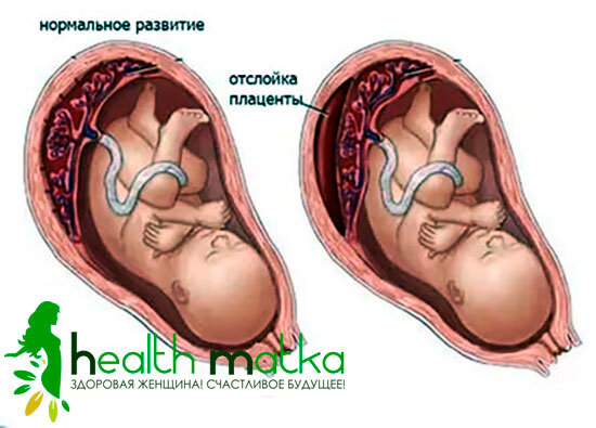 Если отслойка плаценты на ранних сроках беременности что делать — Статьи об онкологии