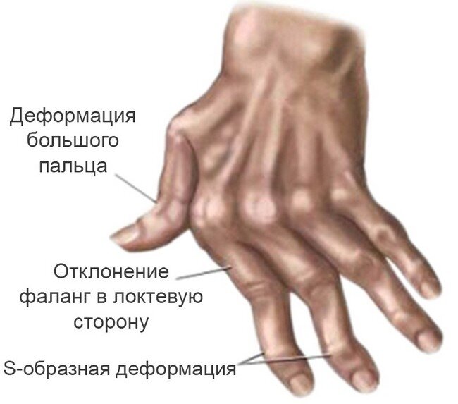 Признаки ревматоидного артрита