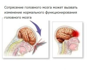 Как определяют сотрясение мозга?