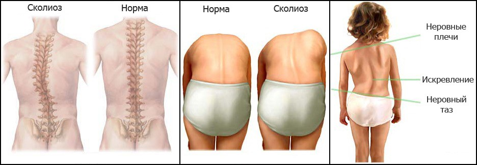 Сколиоз что это. Формы искривления сколиоза. Сколиоз и нормальная спина. Сколиозный позвоночник и нормальный. Сколиоз и норальнчя спина