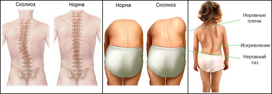 Структурный сколиоз. S образный сколиоз позвоночника. Сколиоз поясничного отдела позвоночника 12 градусов. Правосторонний сколиоз 2 степени. С-образный сколиоз грудо-поясничного отдела.