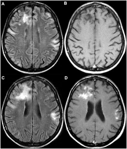  Мультифокальная лейкоэнцефалопатия (прогрессирующая).