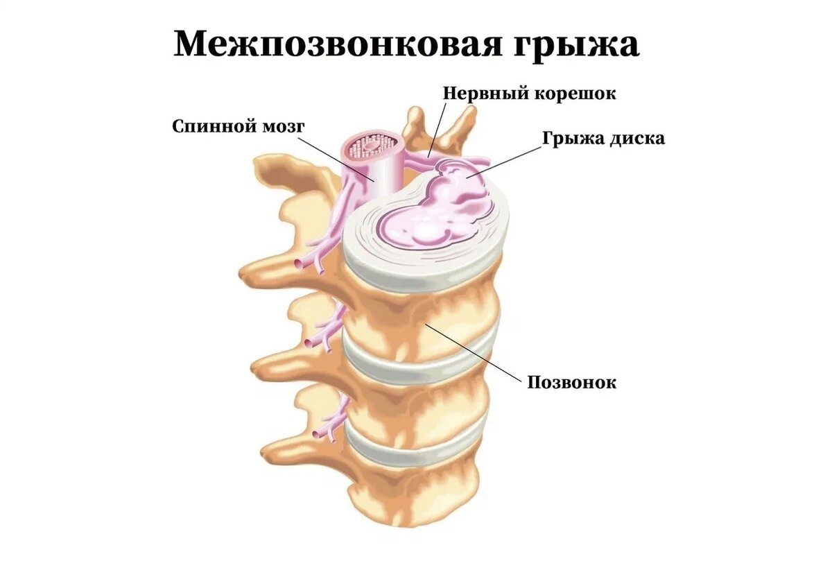 Как проверить грыжу. Межпозвоночная грыжа. Грыжа позвонка. Резорбция межпозвонковая грыжа. Грыжа диска схема