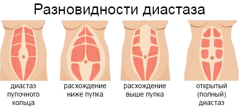 Как выглядит диастаз после родов
