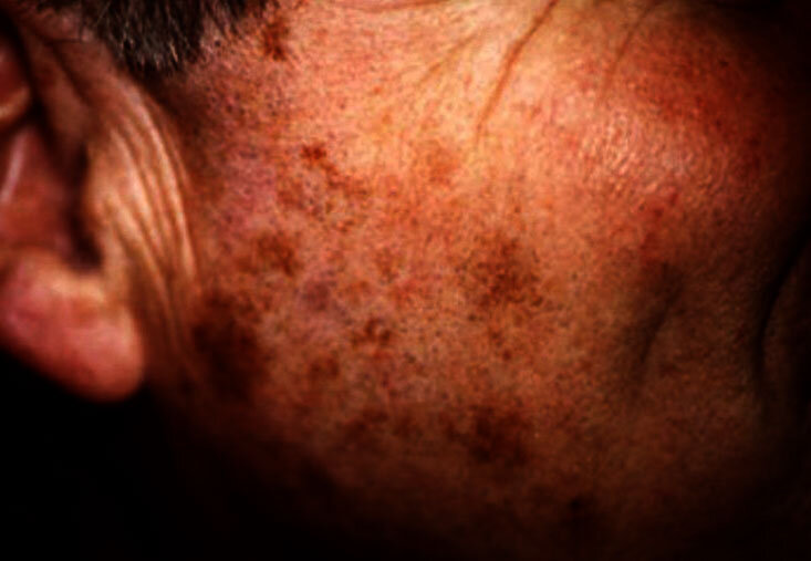 Типичные пигментные пятна