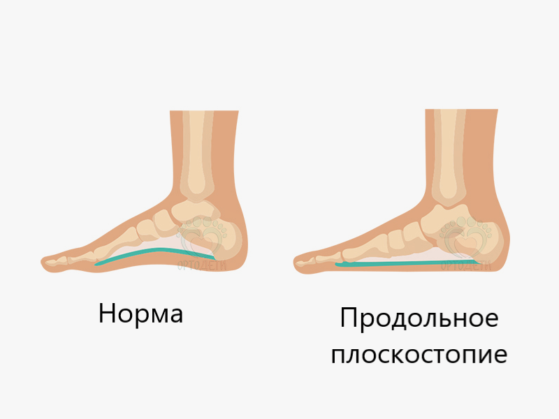 Поперечное плоскостопие картинки