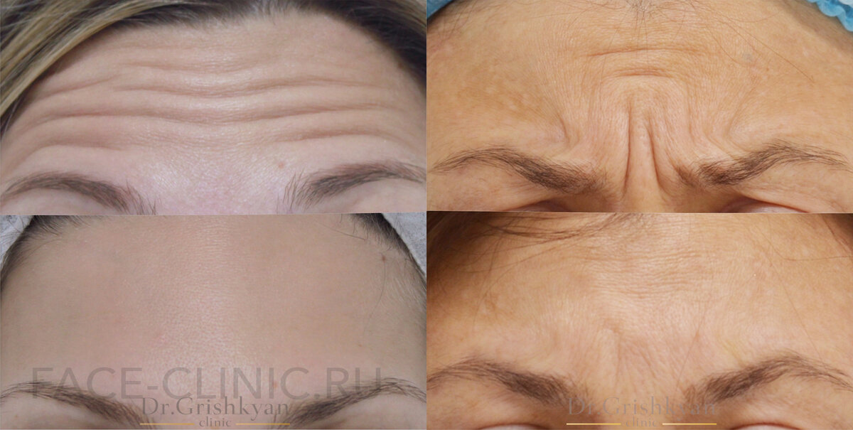 Результат до и после диспорта