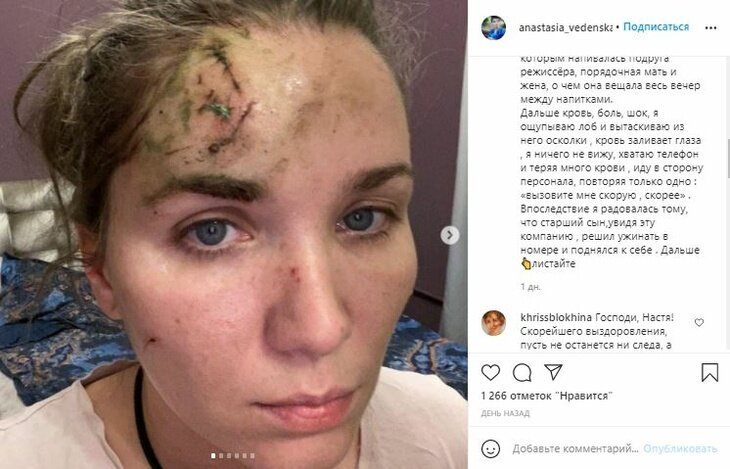 Анастасия Веденская опубликовала фото после драки / Фото: Instagram 