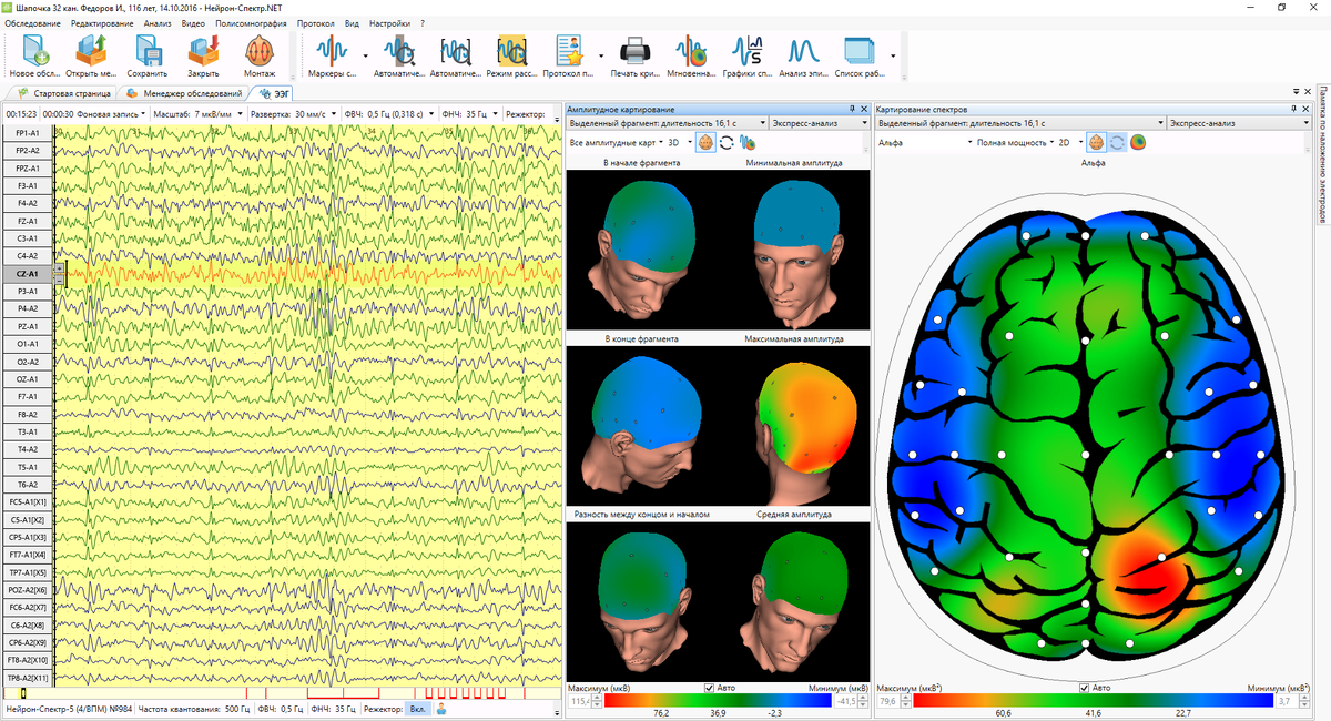 Прибор нейрон спектр 2 энцефалограммы. Ээг картирование. Прибор нейрон спектр 2 энцефалограммы. Ээг картирование. Ээг картирование.