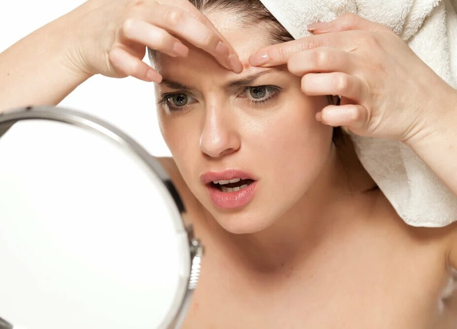 В процессе выдавливания прыща почти всегда происходит нарушение целостности дермы — глубокого слоя кожи, в котором и располагается источник проблемы. После травматизации дермы в процессе последующего заживления неизбежно образуются рубцы. Это второй вариант постакне, остающегося на месте прыщей.