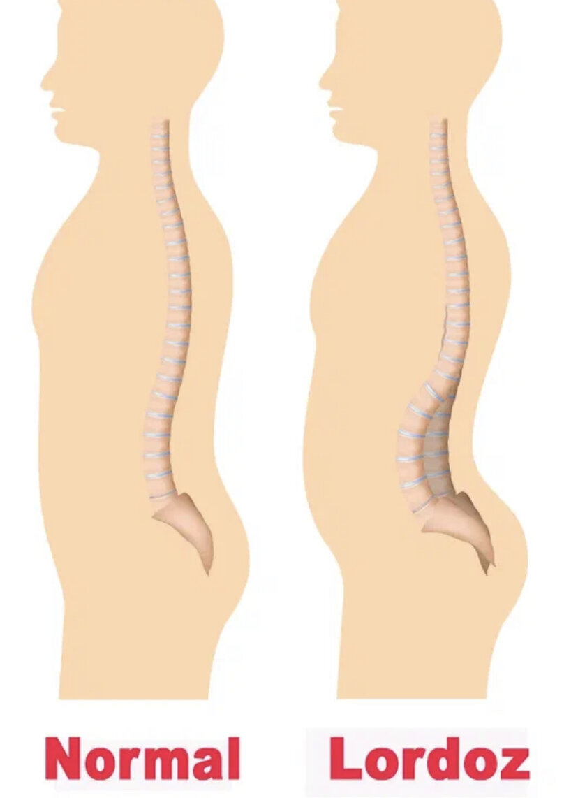 Лордоз поясничного отдела позвоночника. Осанка лордоз. Человек лордоз поясничный. Правильный лордоз поясничного отдела.