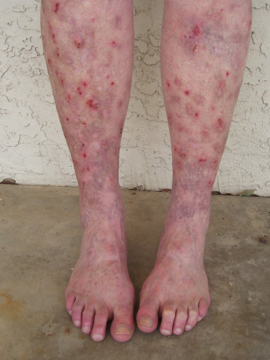 Ноги человека с болезнью Моргеллонов
