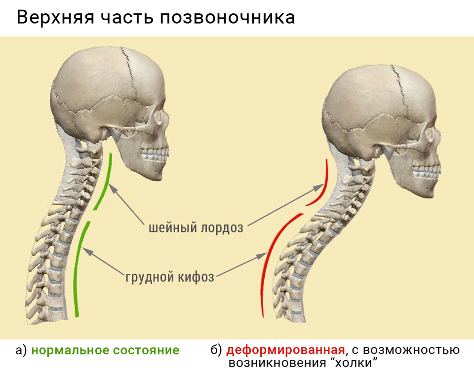 Кифоз шейного отдела позвоночника - симптомы, методы диагностики и лечения