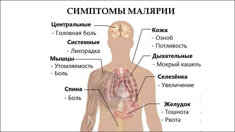 Симптомы малярии. Инфографика с сайта Ppt-online.org
