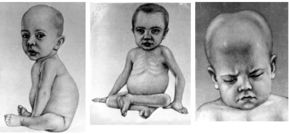 Признаки рахита у ребенка